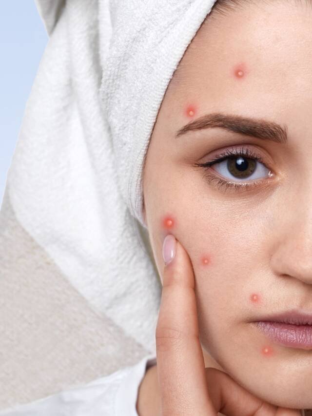 ಮೊಡವೆಗಳು ನಿಮ್ಮ ಸೌಂದರ್ಯವನ್ನು ಕೆಡಿಸುತ್ತಿವೆಯೇ? ಚಿಂತಿಸಬೇಡಿ! ವಾರಕ್ಕೆ 3 ಬಾರಿ ಈ ಫೇಸ್‌ ಪ್ಯಾಕ್‌ ಹಚ್ಚಿ ಮೊಡವೆಗಳಿಂದ ಮುಕ್ತಿ ಪಡೆಯಿರಿ!